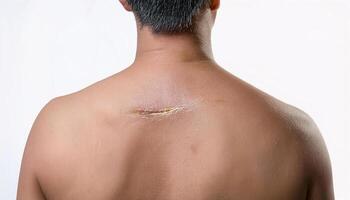 close-up of a deep scar on the upper back, showing detailed healing process and uneven texture in isolated white background photo