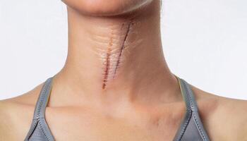 macro shot of a scar on the neck caused by a wire injury during sports, showing thin linear scar tissue with detailed healing texture and slight skin discoloration in isolated white background photo