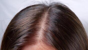 close-up of seborrheic dermatitis on the scalp with visible greasy scales, redness, and irritated skin photo