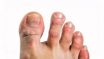 close-up of chilblains on toes with swollen, red, and itchy skin caused by cold exposure, isolated on white background photo