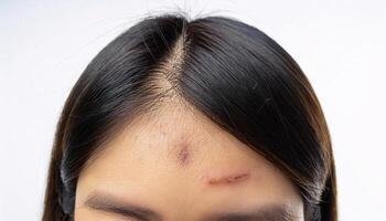 close-up of a scar on the forehead caused by a fall, featuring jagged edges and textured healing in isolated white background photo