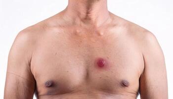 macro view of a cherry angioma on the chest with a bright red raised appearance, isolated on a clean white background photo