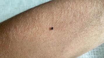 Macro shot of a small tick attached to the skin, emphasizing the texture and detail. Perfect for illustrating health topics, tickborne diseases, and outdoor safety measures video