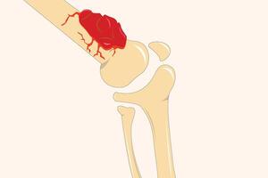 An illustration of osteosarcoma in a knee joint, showing bone damage and tumor growth. eps 10 vector