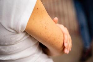 A CloseUp View of an Individuals Arm Featuring Freckles Set Against a Beautifully Blurred Background photo