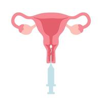Intrauterine insemination infographic. IUI. Uterus and syringe with sperm illustration in cartoon flat style vector