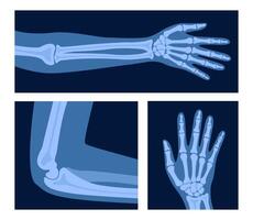 Different x-rays shot of human body part, set. Various x-ray pictures of hand, arm, elbow. illustration. vector