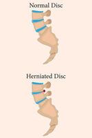 Comparison between normal and herniated spinal discs with clear visual differences. eps 10 vector
