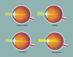 Illustration of most common eye disorders diagram vector