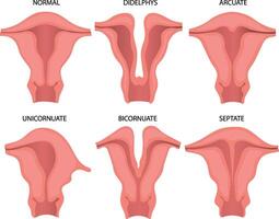 Illustration of Uterine anomalies vector