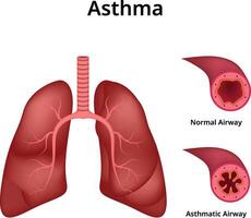 Asthma Normal Airway Asthmatic Airway Design Illustration vector