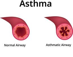 Asthma Normal Airway Asthmatic Airway Design Science Illustration vector