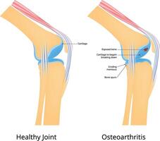 Osteoarthritis Science Design Illustration vector