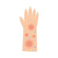 sweat leprosy disease. mycobacterium leprae infection concept vector