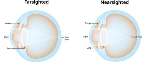 Farsighted Nearsighted Science Design Illustration Diagram vector