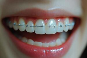 Smiling person showing teeth with braces in close up during daylight photo
