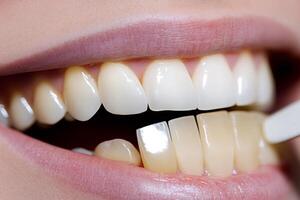 Dentist comparing teeth whitening shade guide with patient's teeth photo
