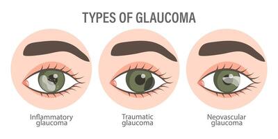 Types of glaucoma. Eyes with glaucoma. Inflammatory, neovascular, traumatic glaucoma. Medical infographic banner vector