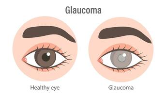 Glaucoma eye. Inflammatory, neovascular, traumatic glaucoma. Medical infographic banner vector