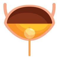 Urinary bladder storing urine with prostate gland showing benign prostatic hyperplasia vector