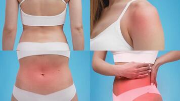 Individuals display severe sunburn on their backs, shoulders, and sides, emphasizing the effects of excessive sun exposure. The images highlight the consequences of neglecting sun protection. video