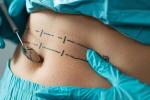 Plastic surgeon preparing abdomen with black marker for operation photo