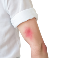 A person's arm showing a red, inflamed area around the elbow, possibly indicating irritation, rash, or allergic reaction. png