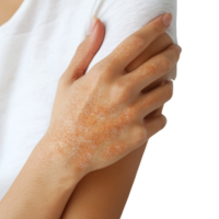 A close-up of a hand with skin irritation, possibly a rash, against a neutral background, highlighting the texture and condition of the skin. png