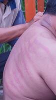 a man with red marks on his back photo
