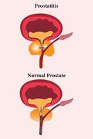 comparation of health prostate and unhealth prostate. prostatitis illustration icon set on white bacground. eps 10 vector