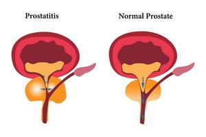 comparation of health prostate and unhealth prostate prostatitis illustration icon set on white bacground eps 10 vector