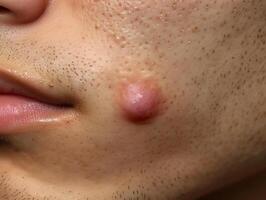 Abscess or nodular acne in the face of European patient. photo