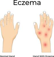 Eczema on Hand Design vector