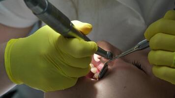 Doctor working with instruments in patient's open mouth for dental treatment video