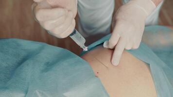 The doctor makes an injection with a large syringe in white gloves close up. video
