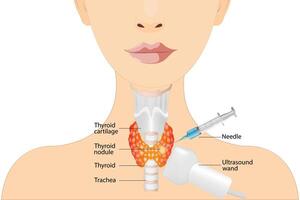 Fine needle aspiration biopsy of the thyroid gland in a patient using an ultrasound machine. Thyroid biopsy vector