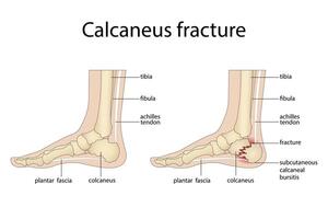 Anatomy of a calcaneal fracture with a diagram of the structure of a broken calcaneus vector