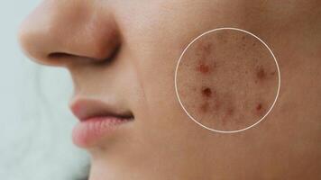 Close-up of a young girl with skin problems. Pimples, acne, pores, scars. Natural skin with and without filters. photo