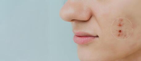 Close-up of a young girl with skin problems. Pimples, acne, pores, scars. Natural skin with and without filters. A place for your text. photo