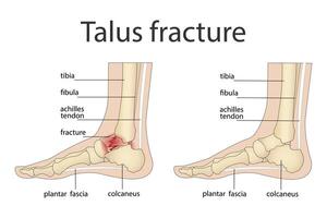 Illustration of bone fractures. Anatomical structure of the human foot with a painful part vector