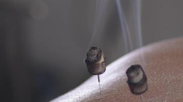 Acupuncture needles with moxas smoking stimulating in a moxibustion session video