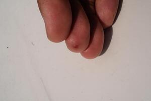 Injured middle finger skin. Wound on middle finger that started to heal after a few days. Health and medicine care. Human skin. Negative space. photo