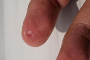 Closeup of injured middle finger skin. Wound on middle finger that started to heal after a few days. Health and medicine care. Human skin. Negative space. photo