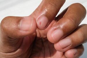 The index finger nail has an incised wound. Work accident in the kitchen which caused a finger injury. Closeup hand fingers. Macrophotography Concepts. photo