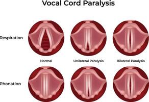 Vocal Cord Paralysis Normal vs Affected Design Illustration vector
