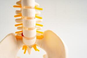 Lumbar spine displaced herniated disc fragment, spinal nerve and bone. Model for treatment medical photo