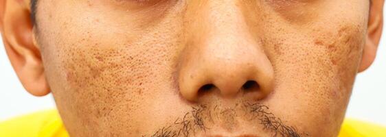 Close-up of a Man's Face Showing Visible Skin Texture and Minor Blemishes with detailed view photo