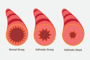 illustration of asthmatic airway, normal airway, asthmatic airway, asthmatic attack airway. eps 10 vector