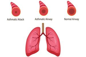 illustration of asthmatic airway, normal airway, asthmatic airway, asthmatic attack airway. medical illustration. medical vector
