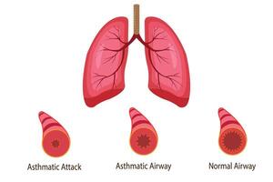 illustration of asthmatic airway, normal airway, asthmatic airway, asthmatic attack airway. medical illustration. eps 10 vector